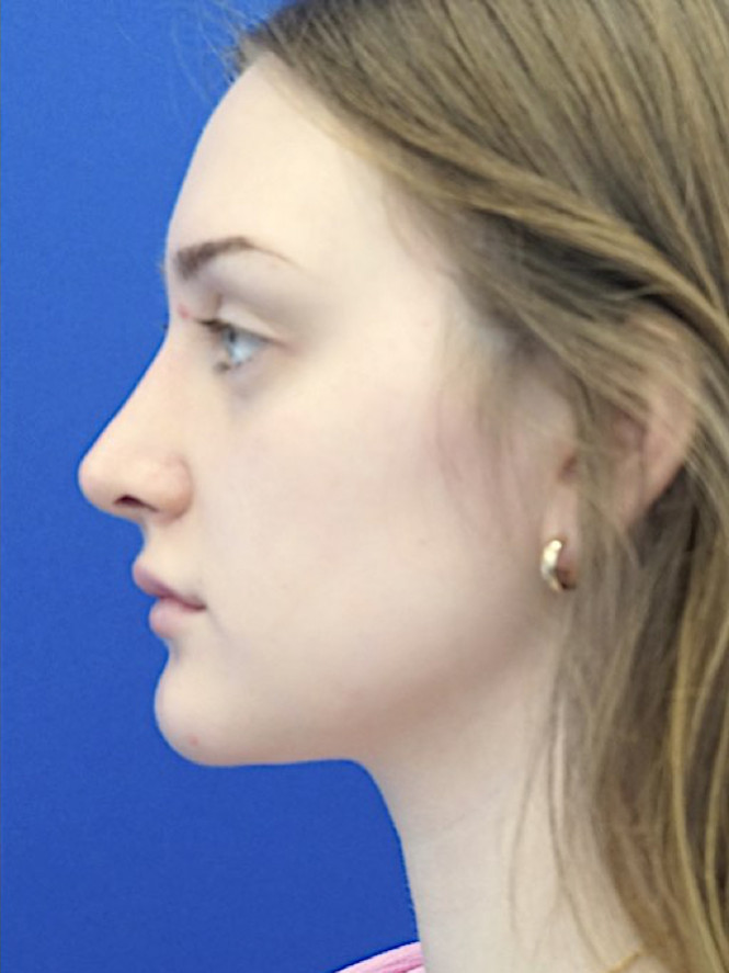 Natural Profile — After