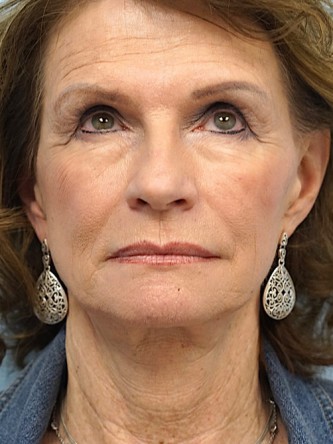 Face/Necklift, Aging Eyelid Surgery, Facial Fat Graft, Laser Resurfacing* — Before