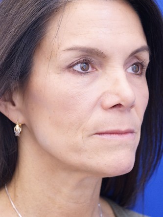 Nasal Tip Deformity — After
