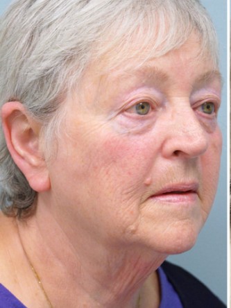 Aging Eyelid, Facelift, Necklift, Fractional CO2 Laser Resurfacing* — Before