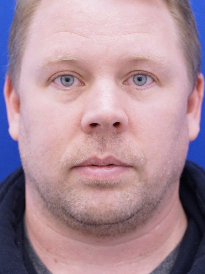 Mild Nasal Deviation — Before