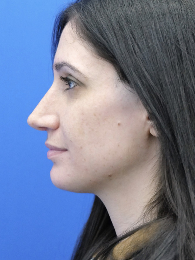 Profile Enhancement — After