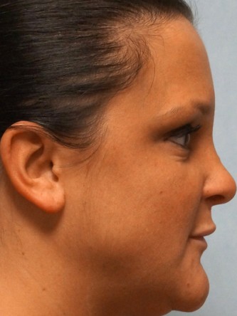 Juvederm to Upper & Lower Lips* — After