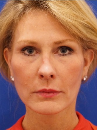 Mini Facelift* — After