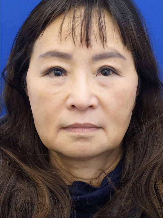 Asian Upper Eyelid Rejuvenation — After