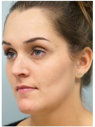 Nasal Septal Perforation1* — Before