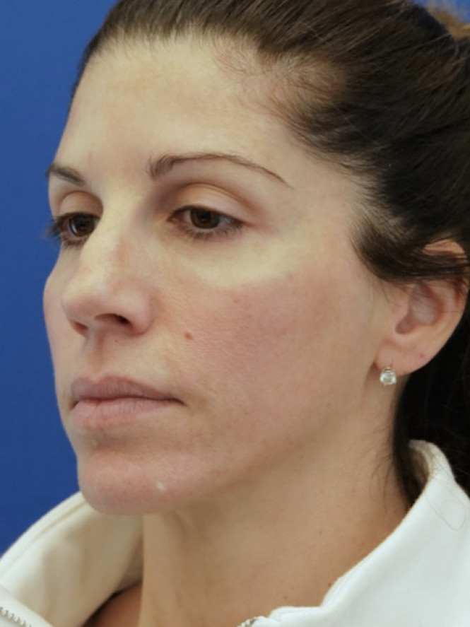 Brow Tip Aesthetic Line — Before