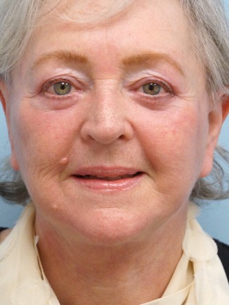 Aging Eyelid, Facelift, Necklift, Fractional CO2 Laser Resurfacing* — After
