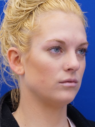 Restylane Silk Equalizes Lip Volume* — After