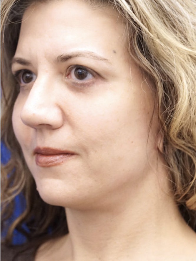 Deep Plane Face Lifting — After