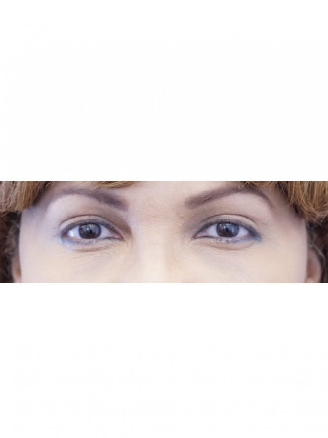 Elegant Eyelid Crease — After