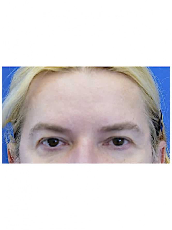 Cat Eye Blepharoplasty Browlift — Before