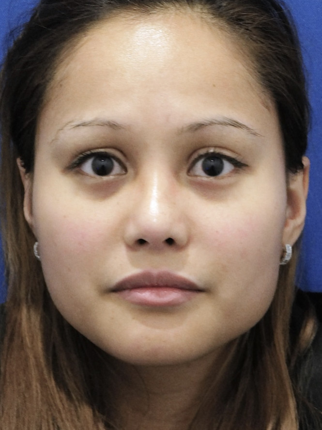 Eyelid Crease Deepening — After