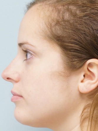Crooked Nose Endonasal Technique1* — Before