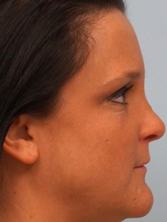 Juvederm to Upper & Lower Lips* — Before