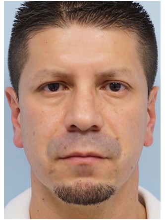 Protruding Ears – Upper Third* — After