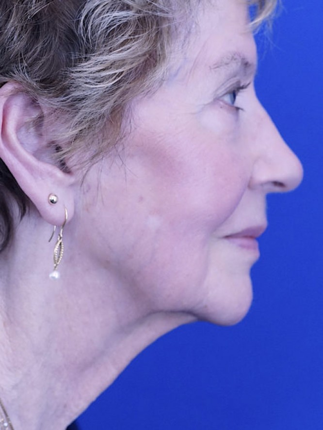 Deep Plane Facial Rejuvenation — Before