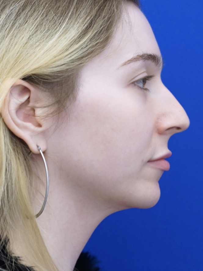 Soften Nasal Contour — Before