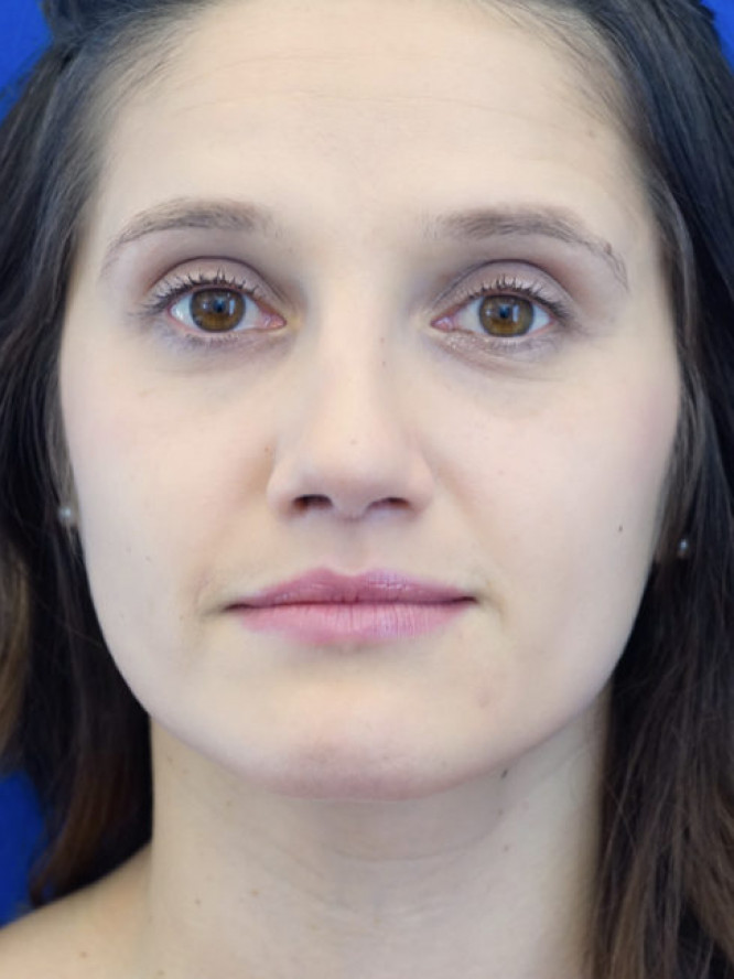 Nasal Profile Bliss — After