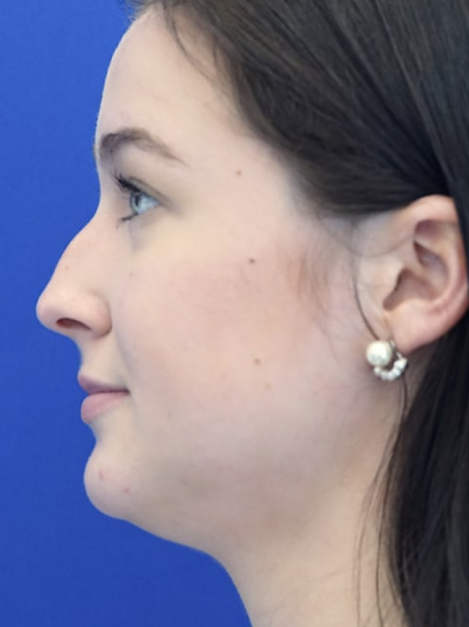 Soften Nasal Bridge — Before
