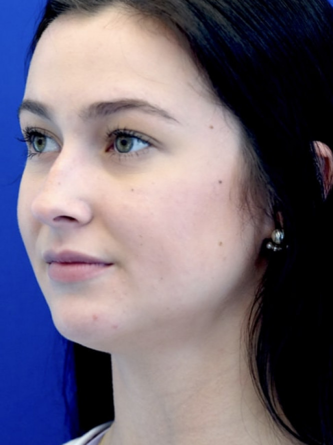 Soften Nasal Bridge — Before