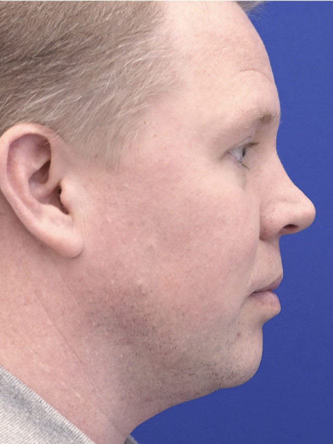 Mild Nasal Deviation — After