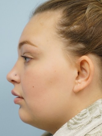 Restylane Silk Achieves Voluptuous Lips* — After