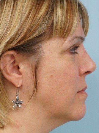 Cheek Augmentation using Voluma* — Before