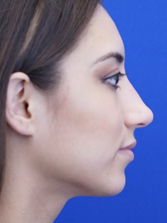 Feminine Nasal Tip* — After