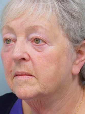 Aging Eyelid, Facelift, Necklift, Fractional CO2 Laser Resurfacing* — Before