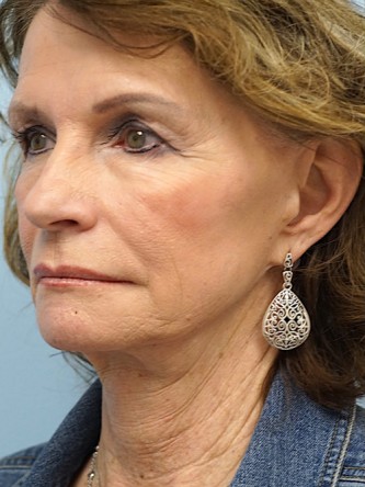 Face/Necklift, Aging Eyelid Surgery, Facial Fat Graft, Laser Resurfacing* — Before