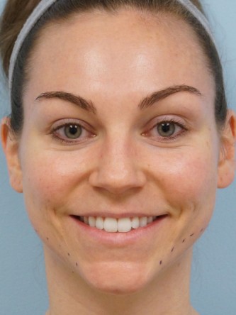Fractional CO2 Laser Skin Resurfacing1* — Before