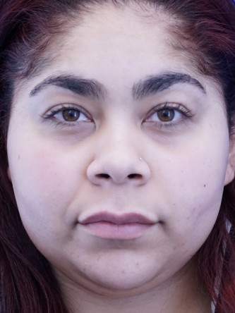 Restylane Silk Balances Lip Fullness* — After