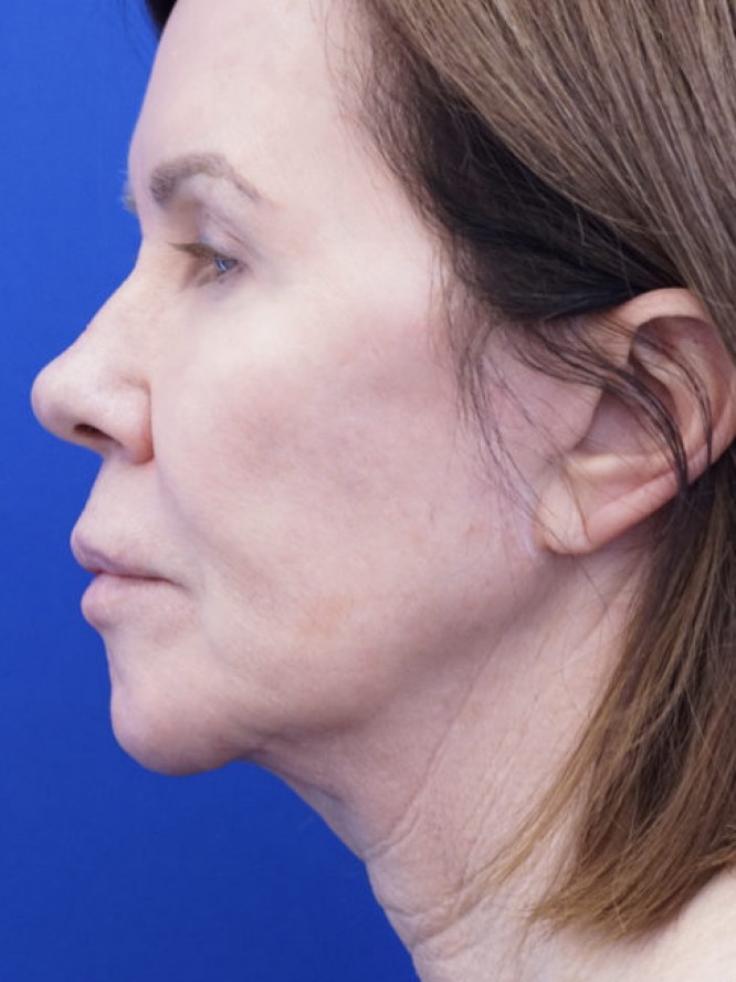 Secondary Lift and Facial Fat Grafting — Before