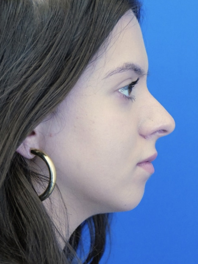 Preservation Rhinoplasty2 — Before