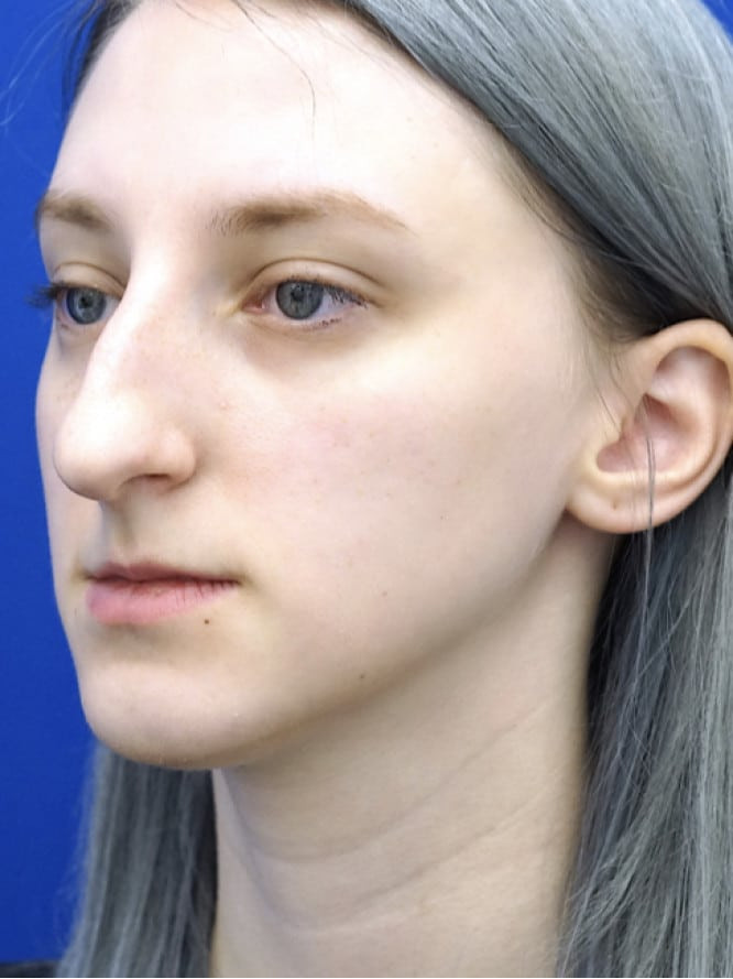 Dorsal Hump and Tension Tip — Before