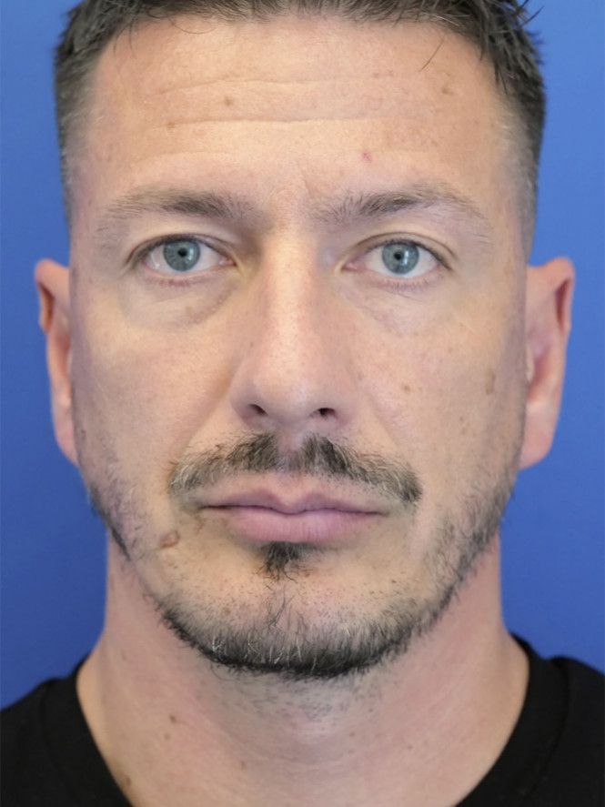 Vertical Lengthening Chin Augmentation — After