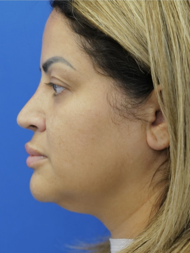 Narrow Nostril Base — Before