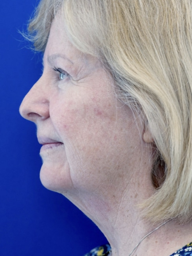 Deep Plane Jowl and Neck Lift — Before