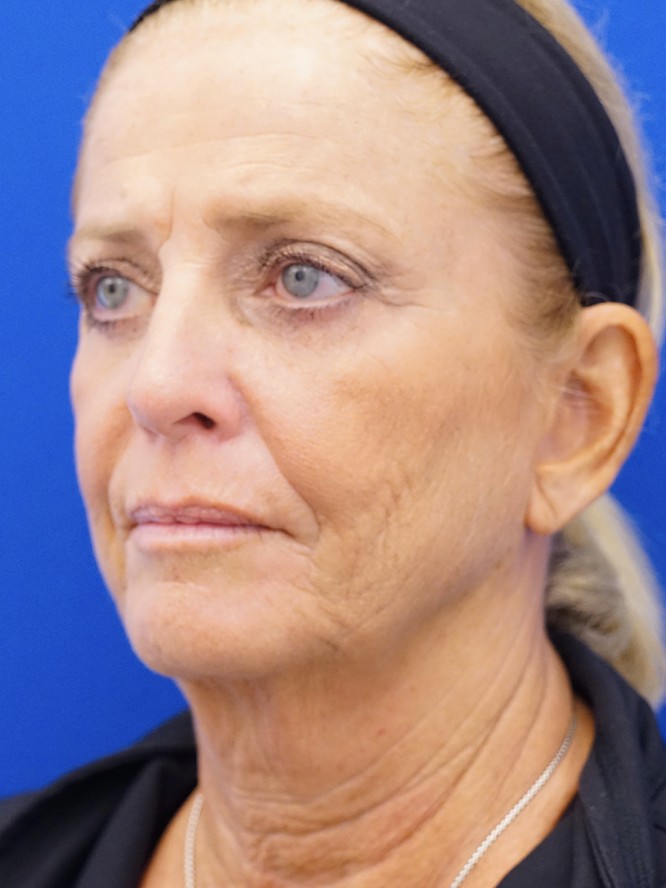 Deep Plane Lower Facelift — Before