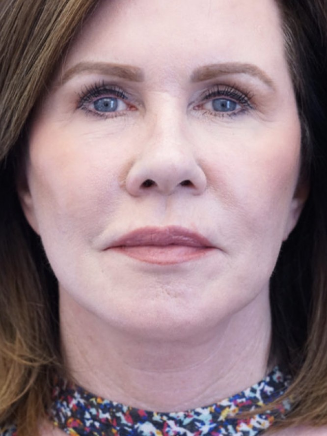 Secondary Lift and Facial Fat Grafting — After