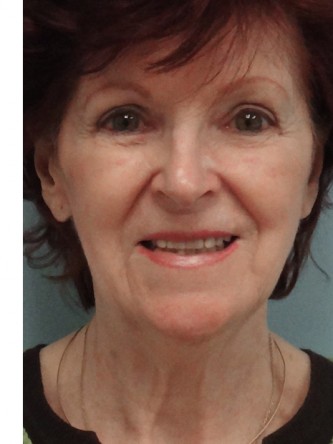 Facelift, Necklift, Platysmaplasty, ERB:YAG Laser Resurfacing* — Before