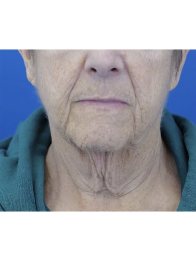 Neck Tissue Laxity — Before