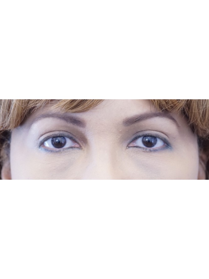 Elegant Eyelid Crease — After