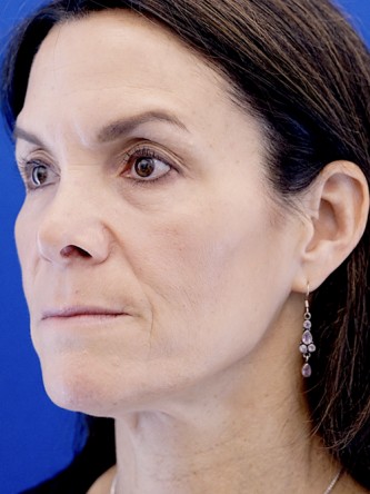 Nasal Tip Deformity — Before