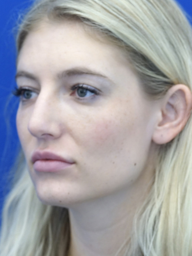 Aesthetic Nasal Contour — Before