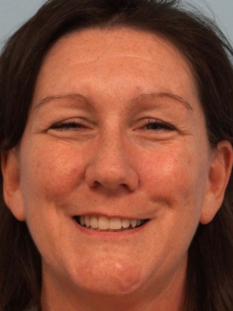 Botox Browlift2* — Before