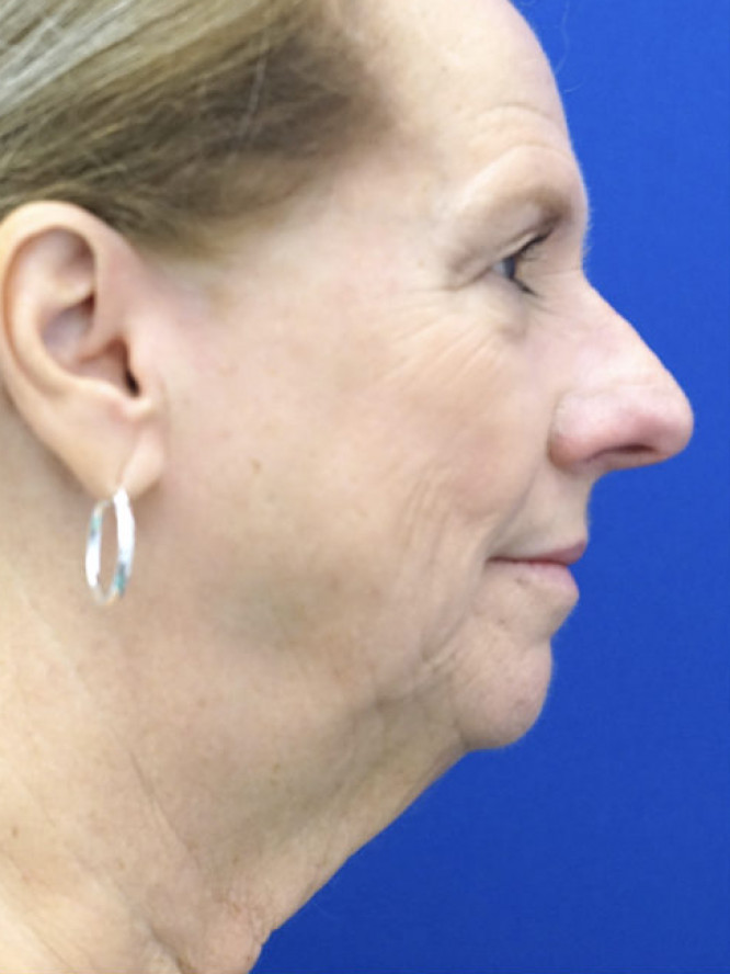 Lower Facial Aging and Fullness — Before