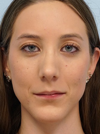 Nasal Hump Endonasal Rhinoplasty* — After