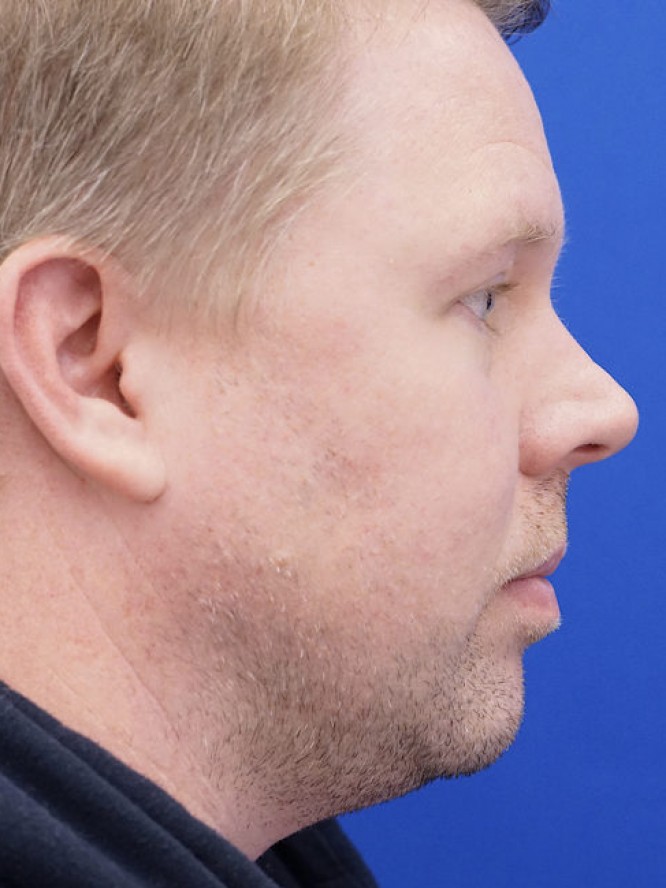 Mild Nasal Deviation — Before